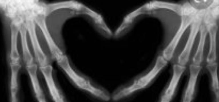 xray heart